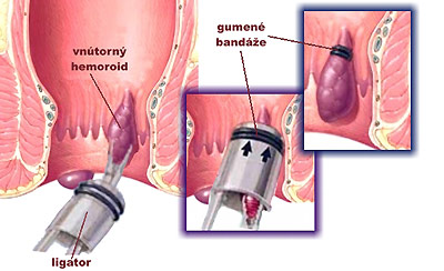 Ošetrenie hemoroidov